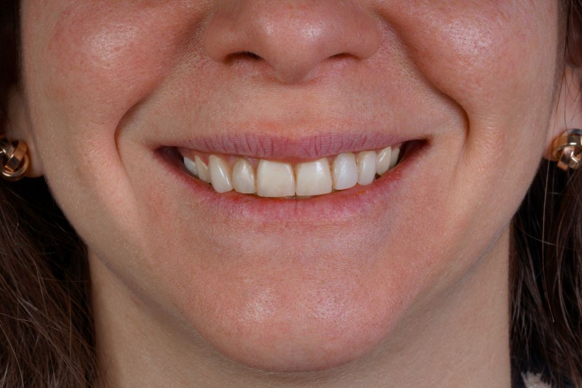 Before Porcelain Veneers