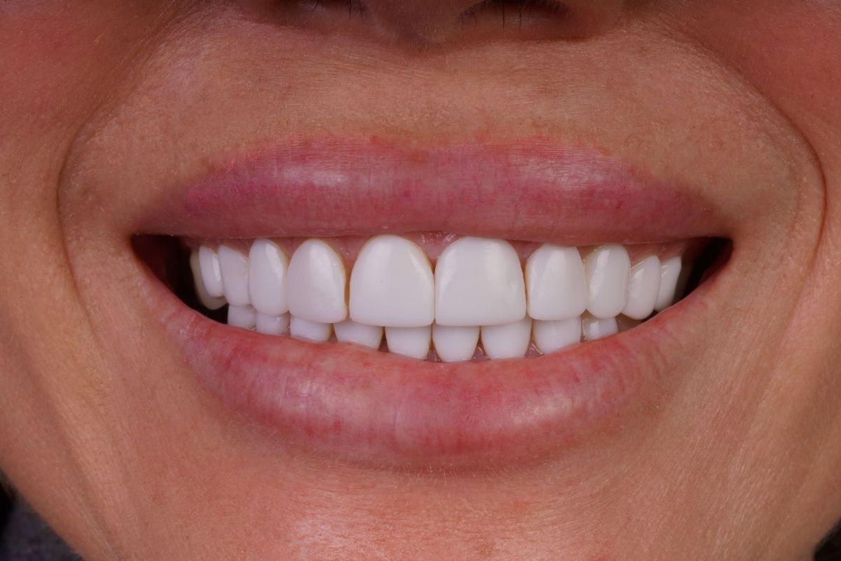 After Porcelain Veneers