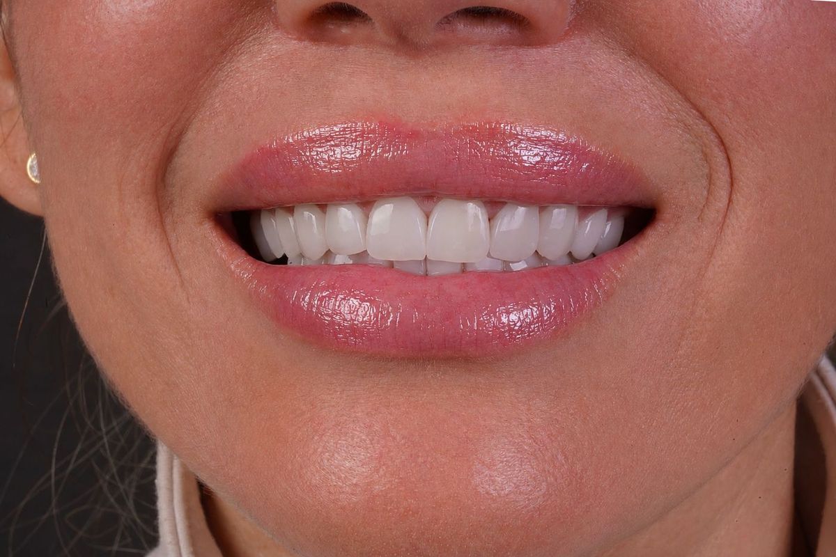 Before Porcelain Veneers