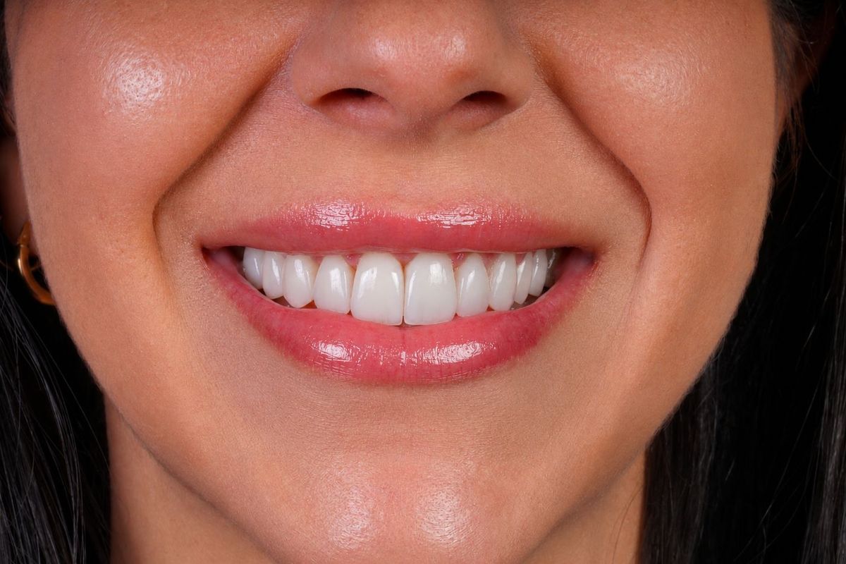 After Porcelain Veneers