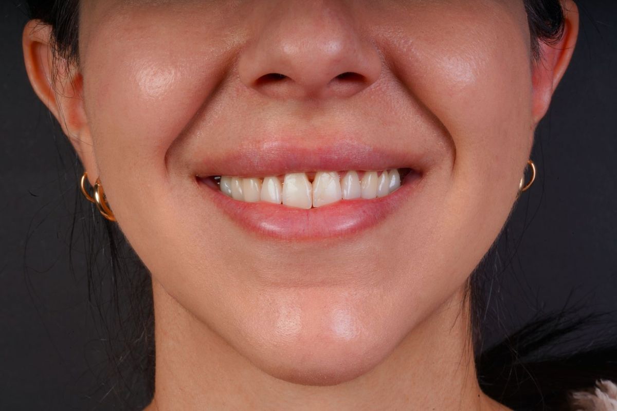 Before Porcelain Veneers