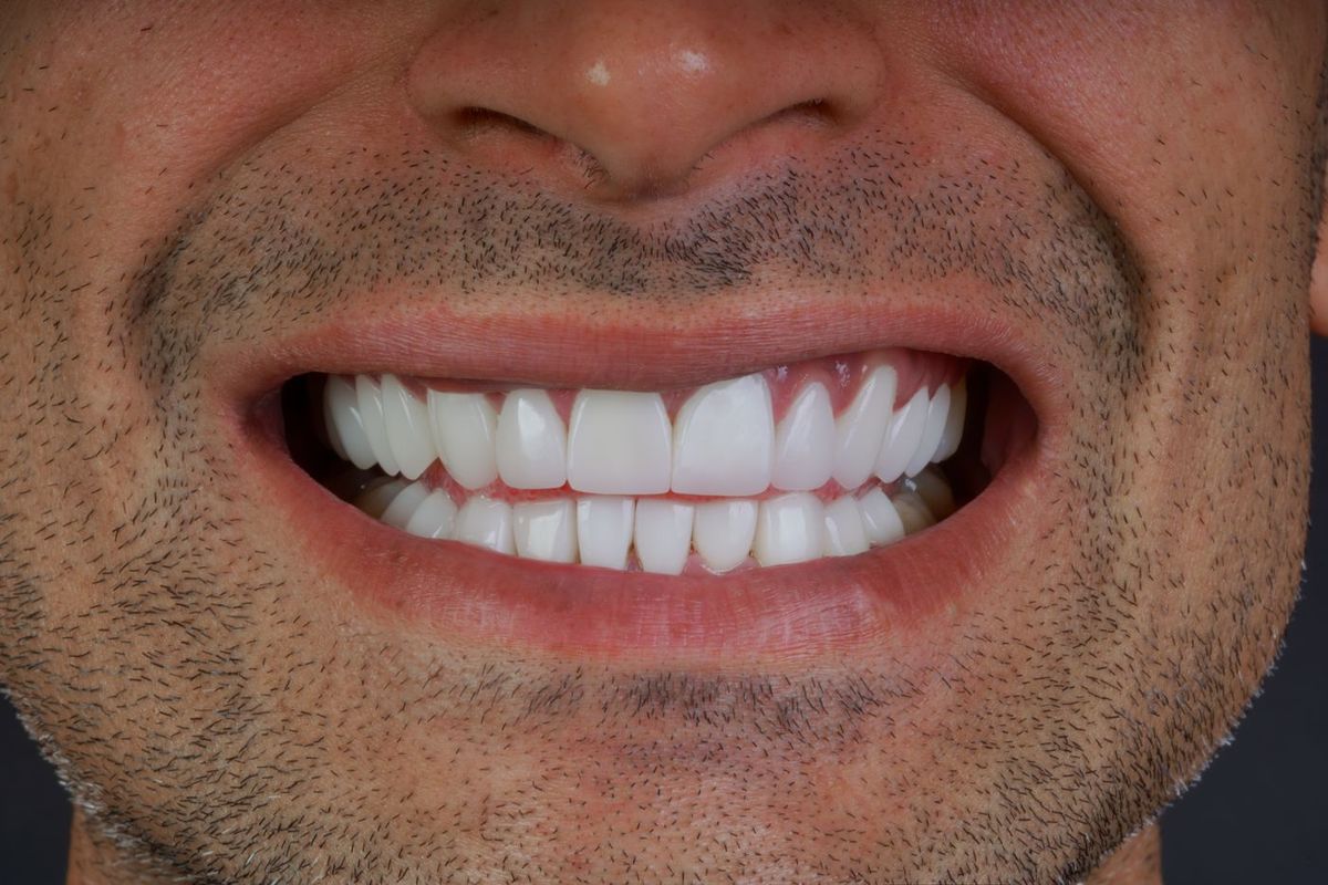 After Porcelain Veneers