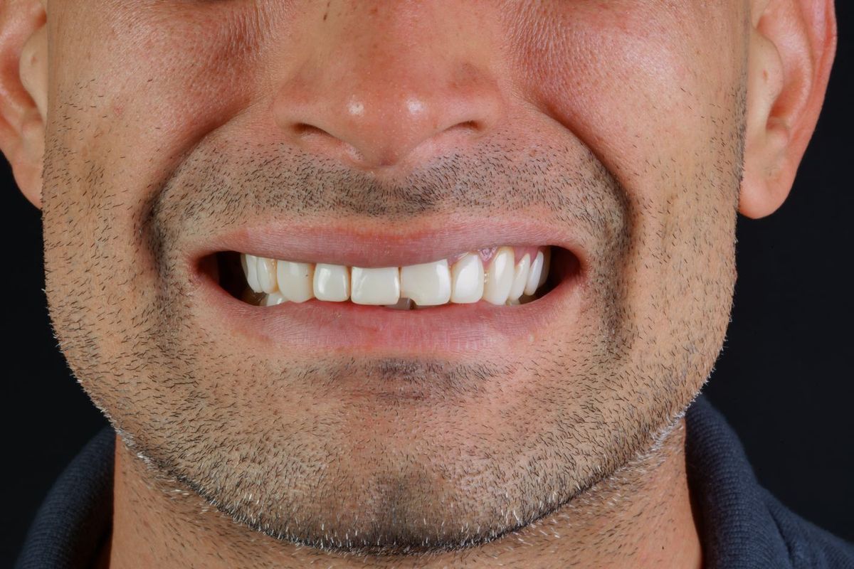 Before Porcelain Veneers