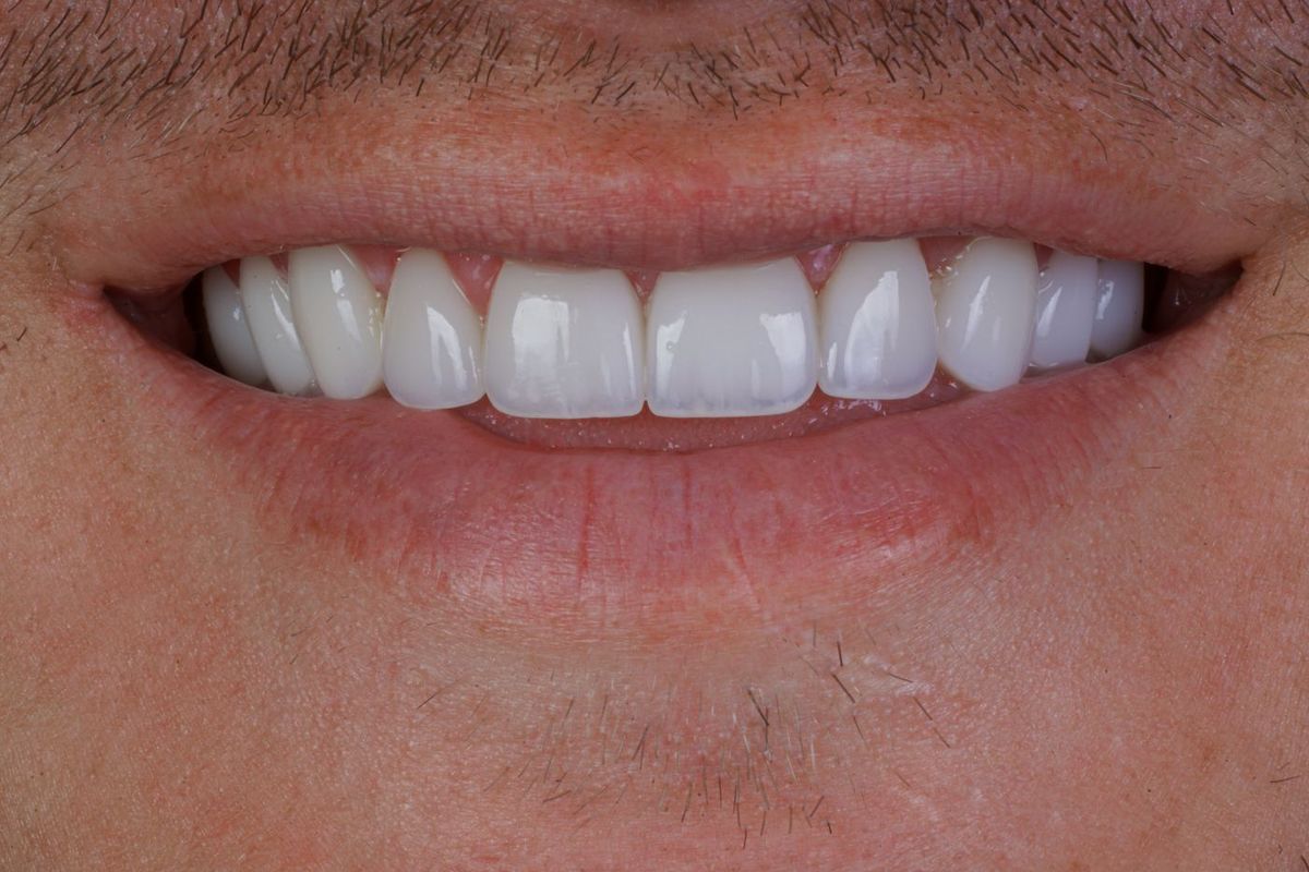 After Porcelain Veneers