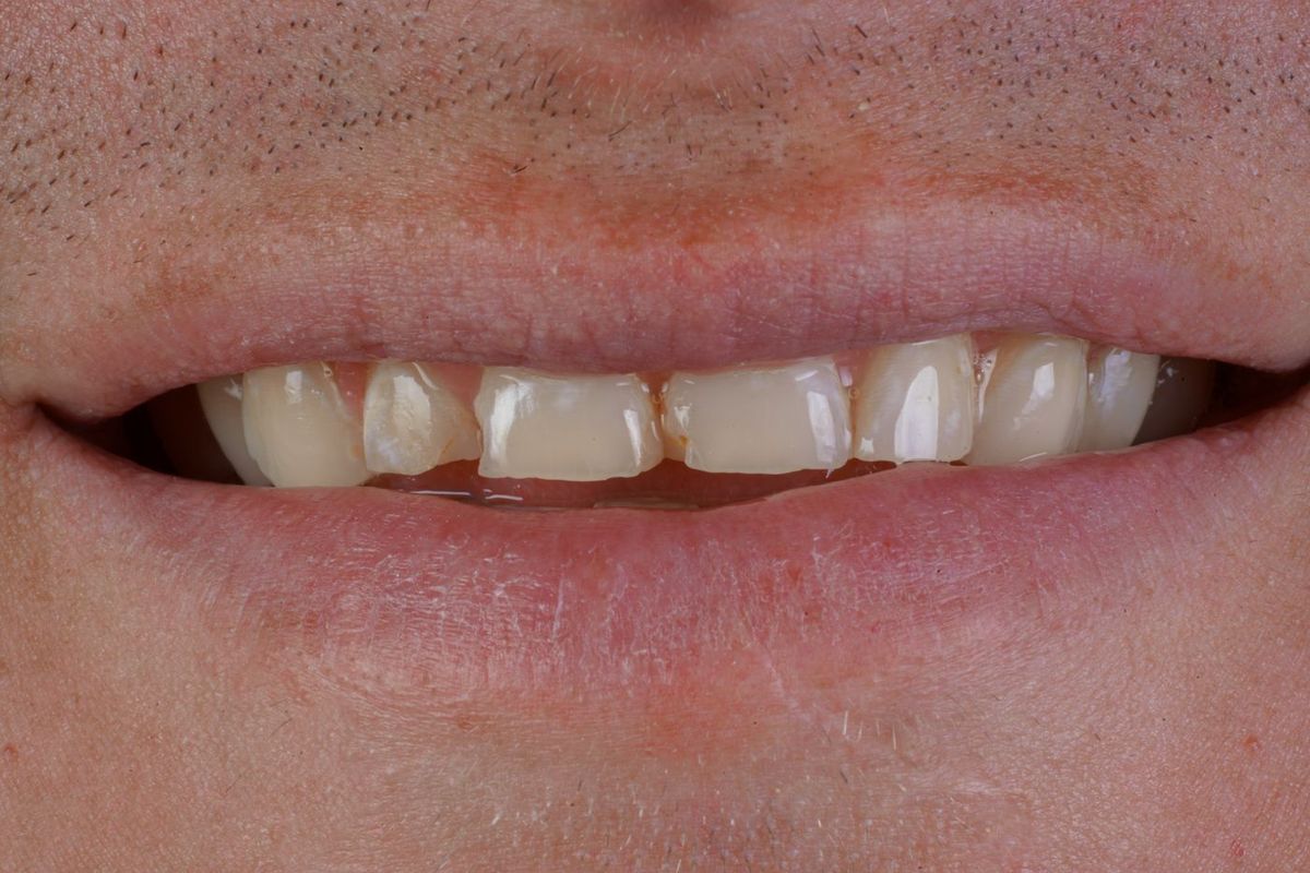 Before Porcelain Veneers