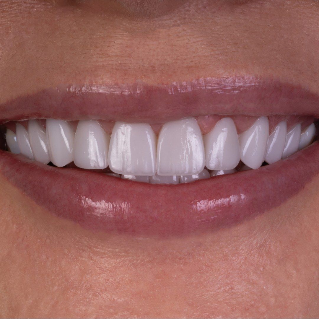After Porcelain Veneers