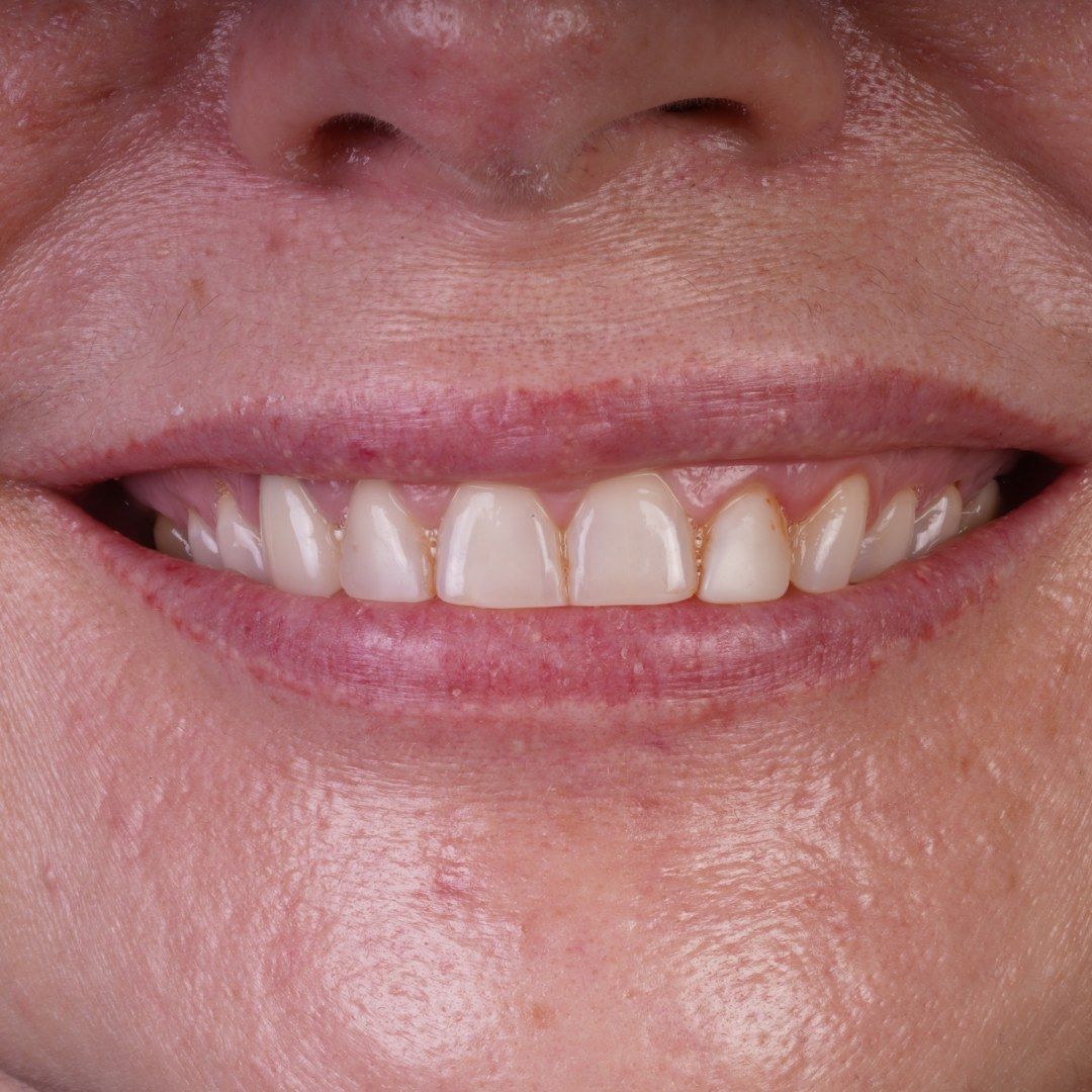Before Porcelain Veneers