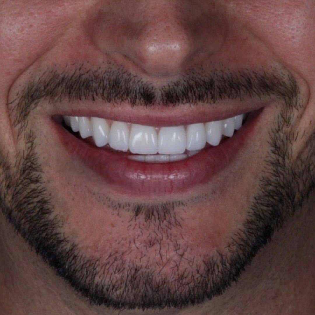 After Porcelain Veneers
