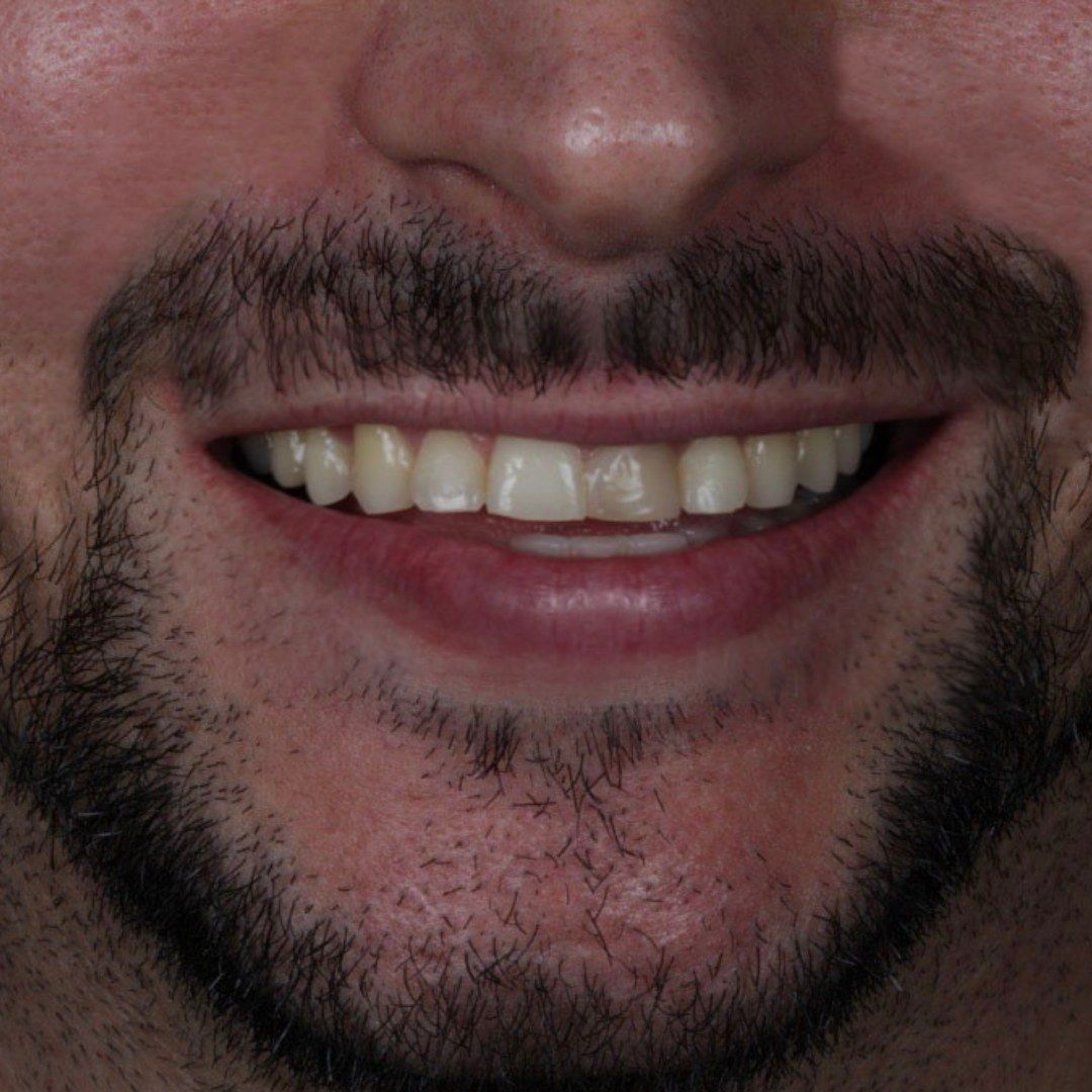 Before Porcelain Veneers