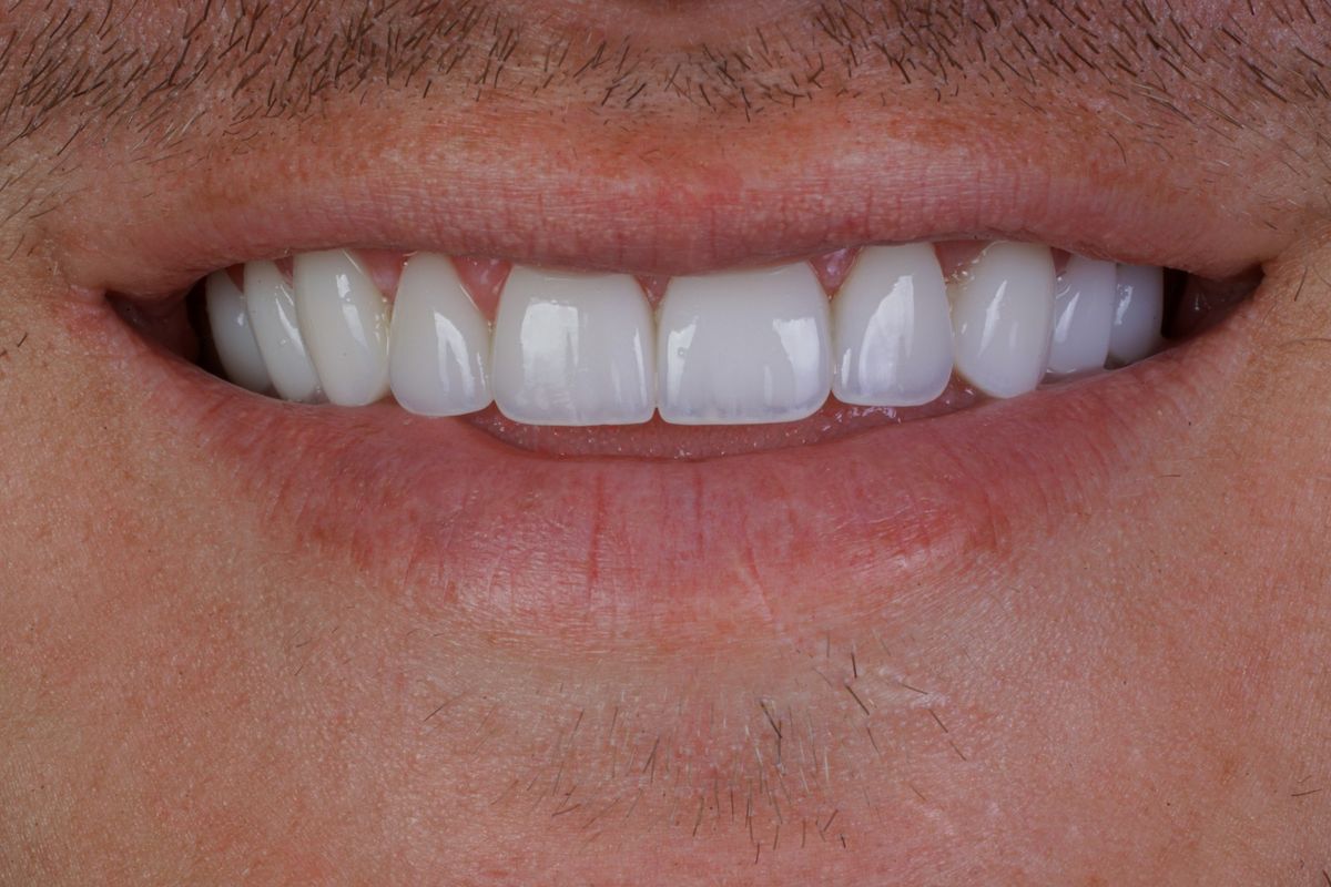 After Porcelain Veneers