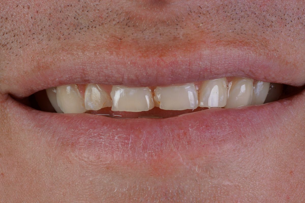 Before Porcelain Veneers