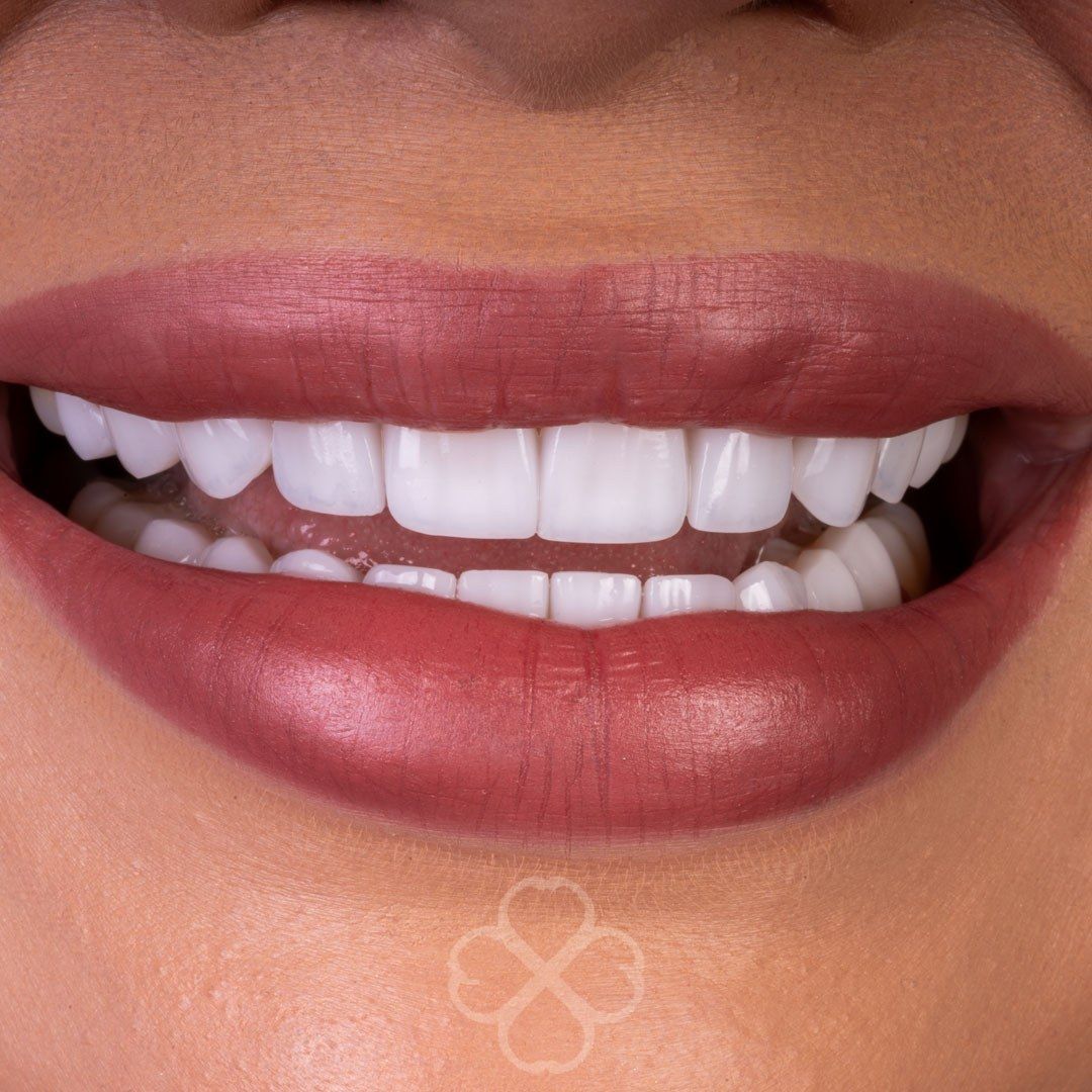 After Porcelain Veneers