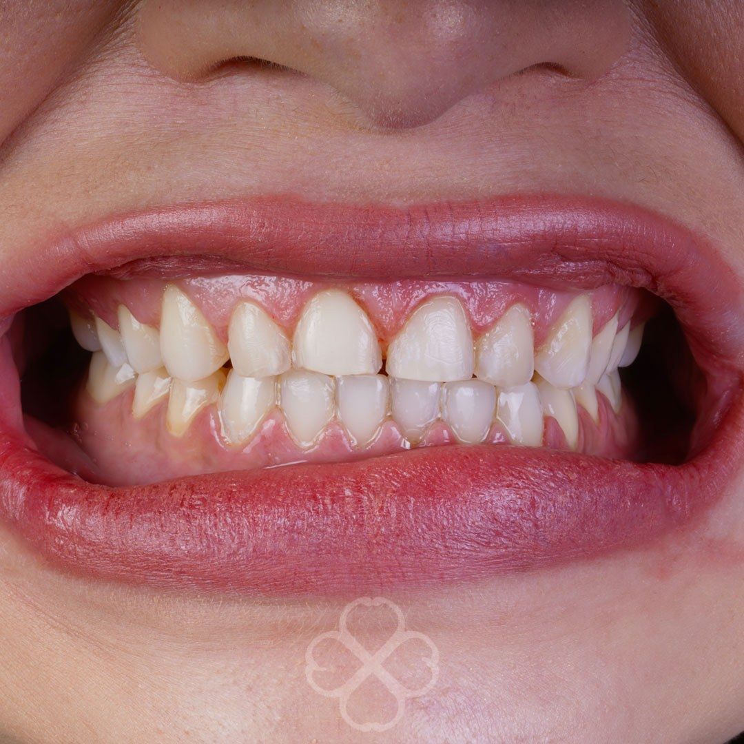 Before Porcelain Veneers