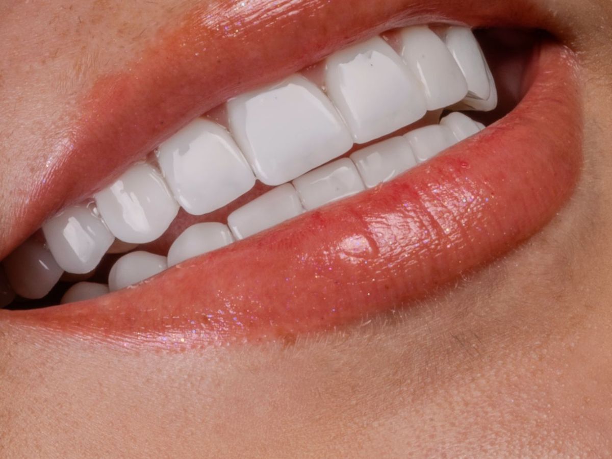 After Porcelain Veneers