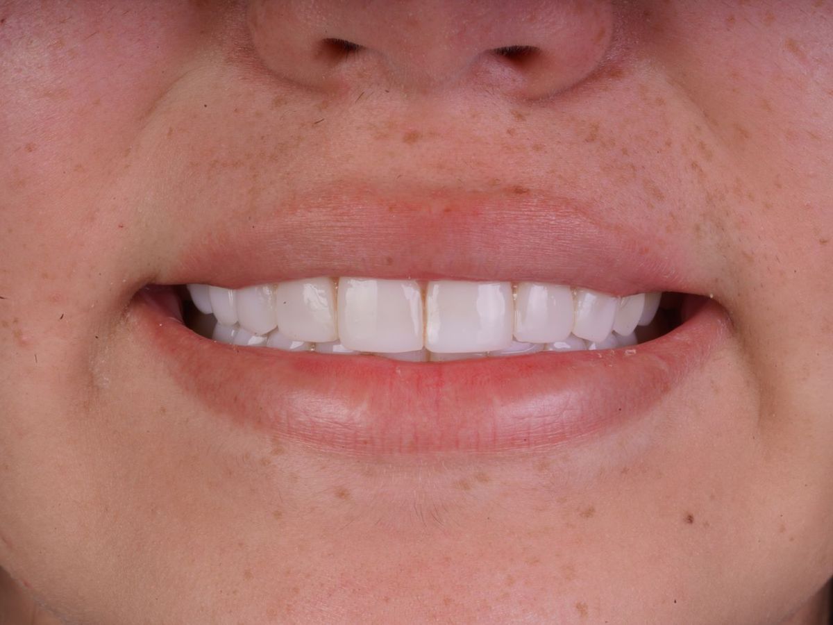 Before Porcelain Veneers