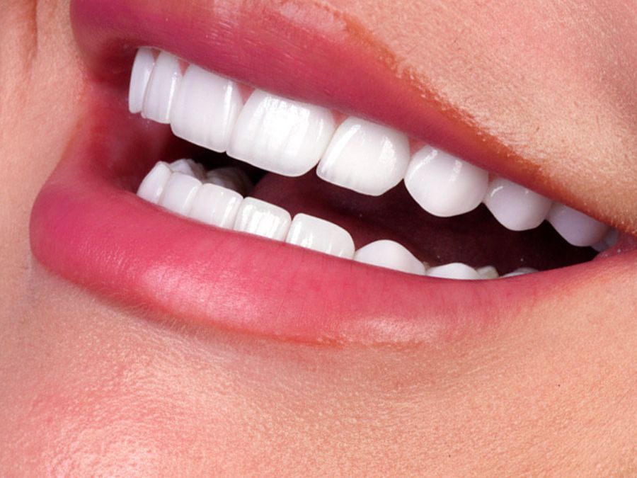 After Porcelain Veneers