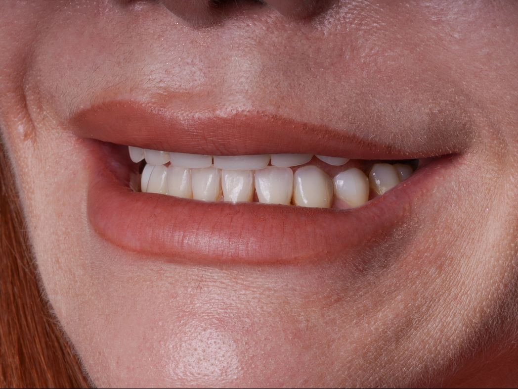 Before Porcelain Veneers