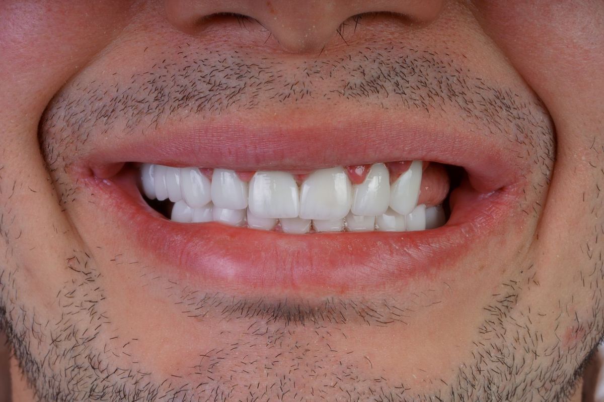 After Porcelain Veneers