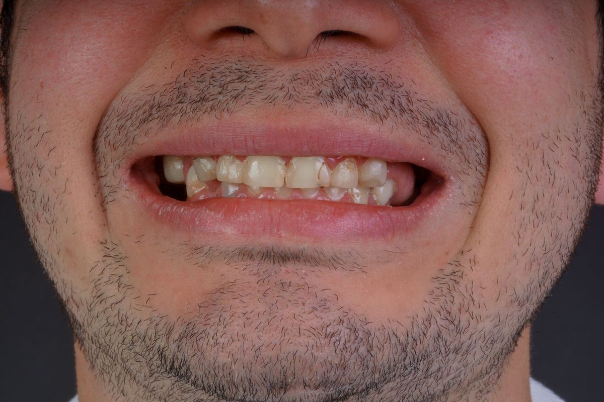 Before Porcelain Veneers