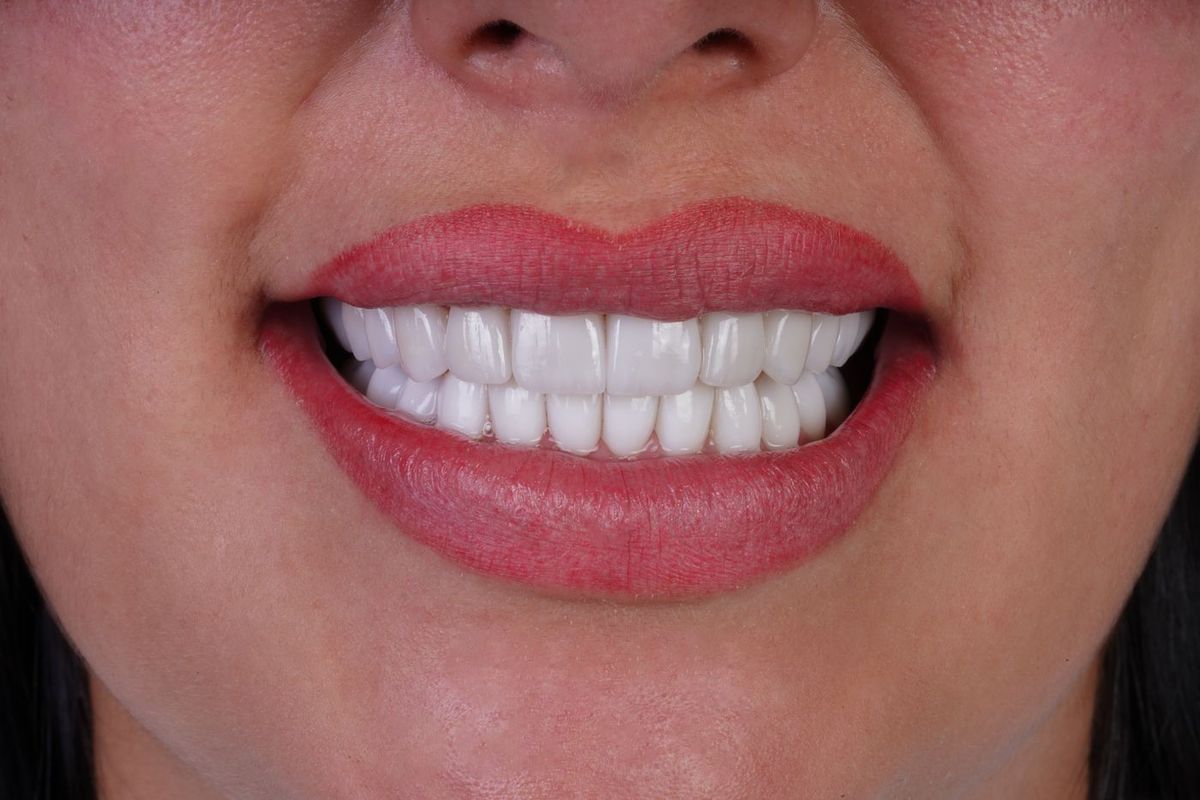 After Porcelain Veneers
