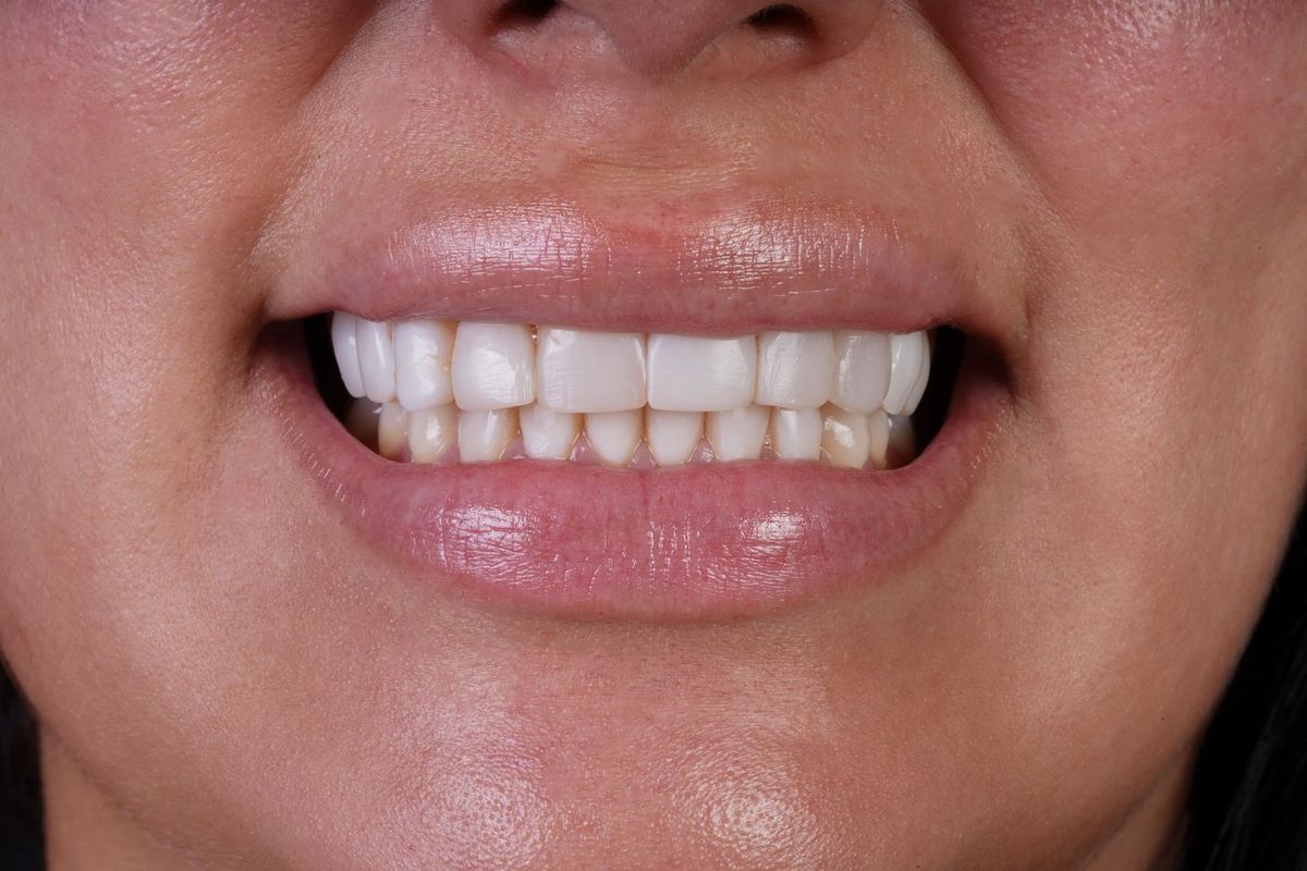 Before Porcelain Veneers