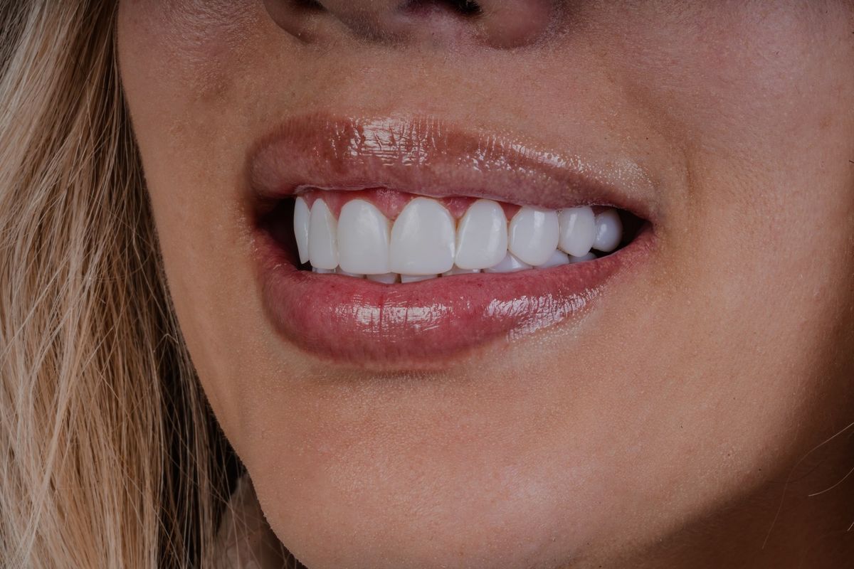 After Resin Veneers