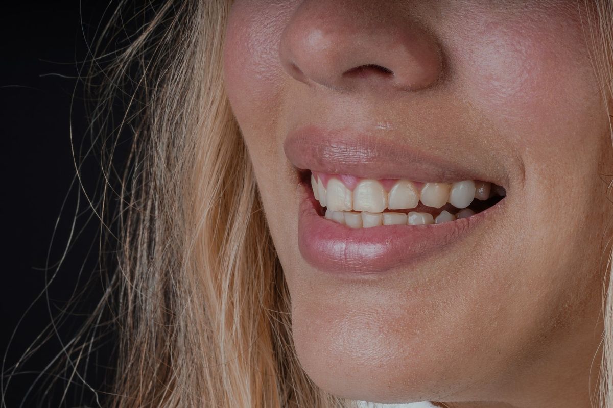 Before Resin Veneers