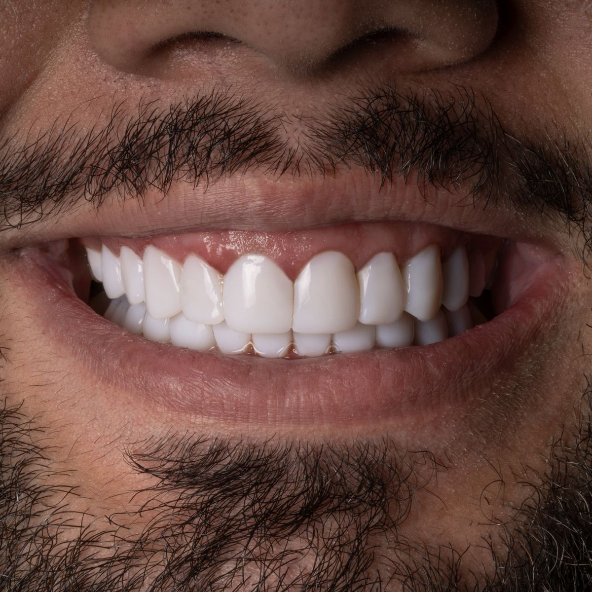After Resin Veneers