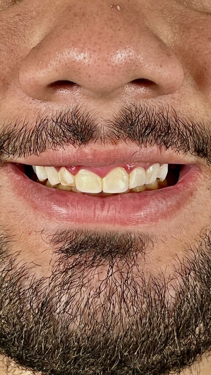 Before Resin Veneers