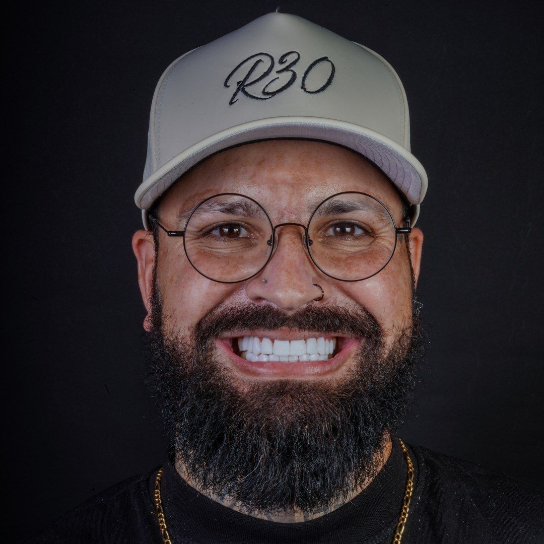 After Resin Veneers