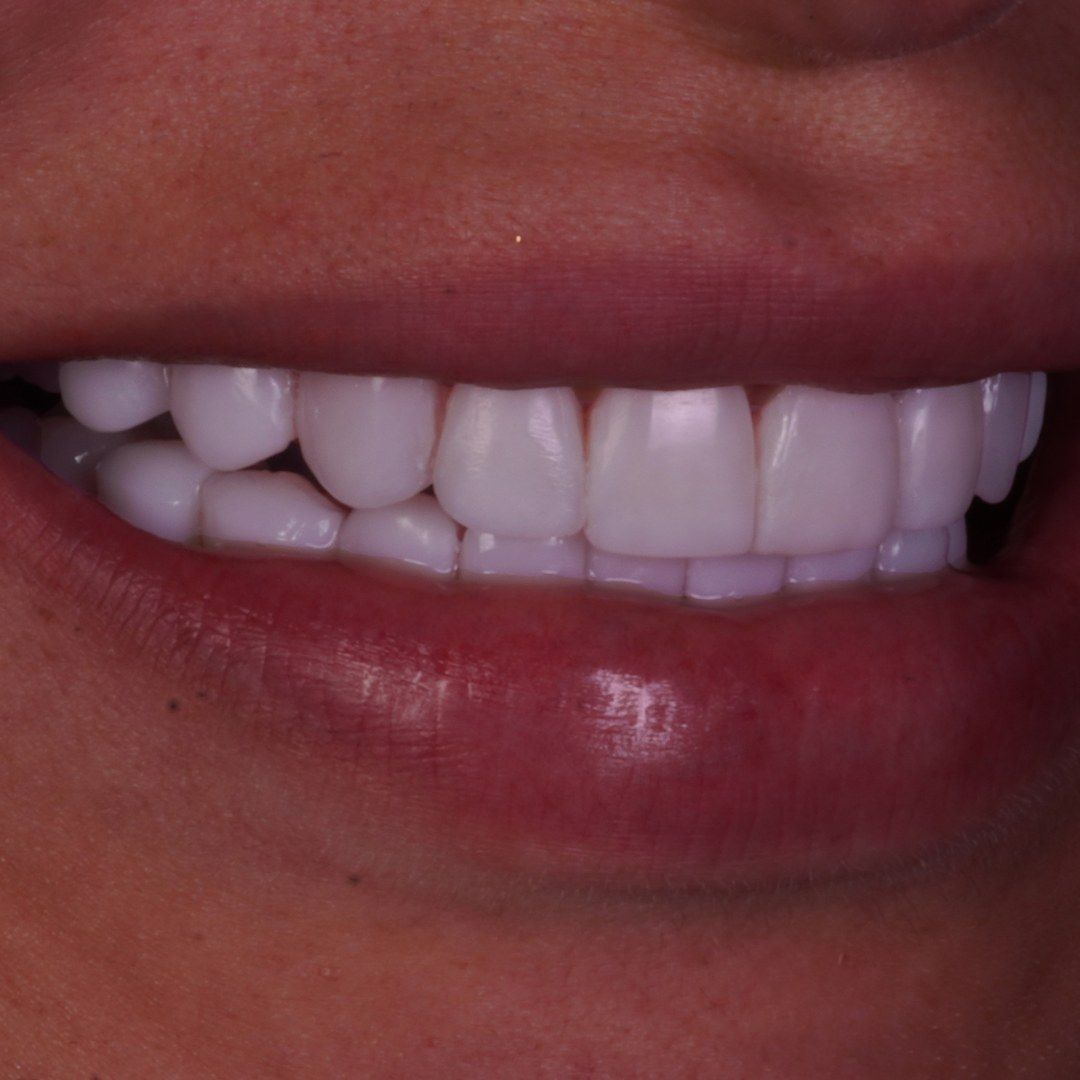 After Resin Veneers