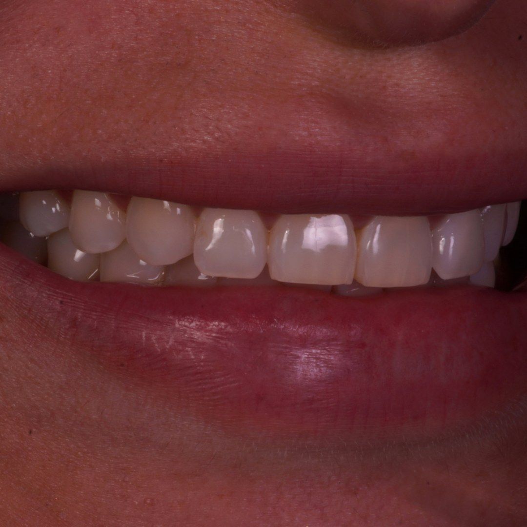 Before Resin Veneers