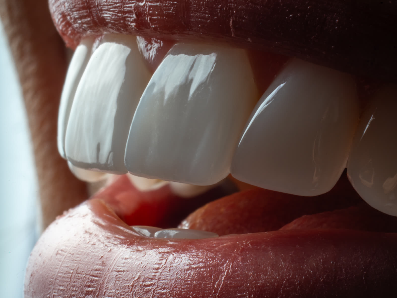 Porcelain Veneers at Andreina Jativa DMD