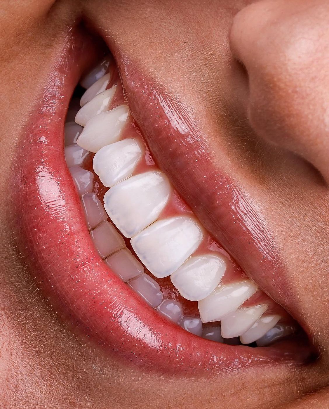 Gingivectomy at Andreina Jativa DMD