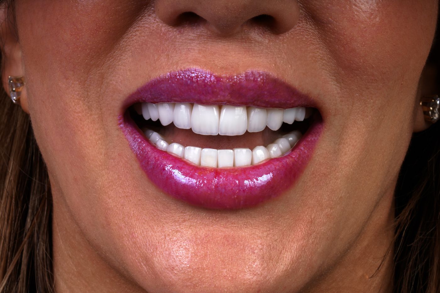 Teeth Whitening at Andreina Jativa DMD