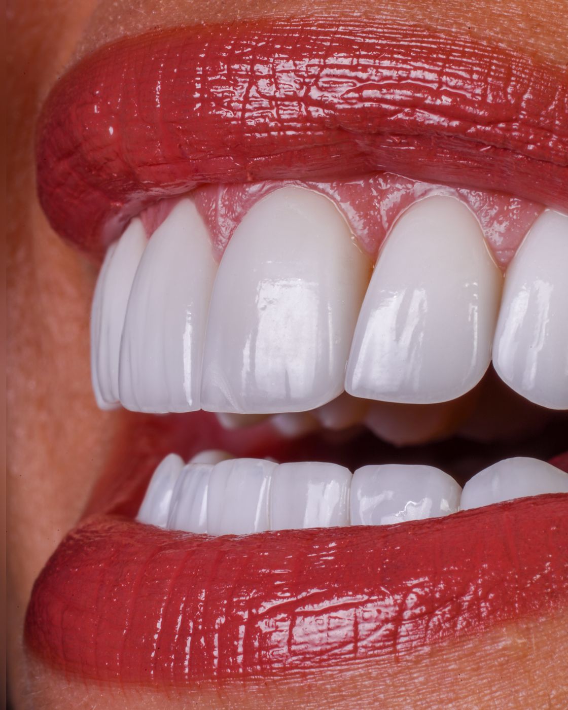 Resin Veneers at Andreina Jativa DMD